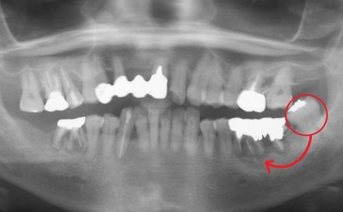 初診時の口腔内所見：症例2-1