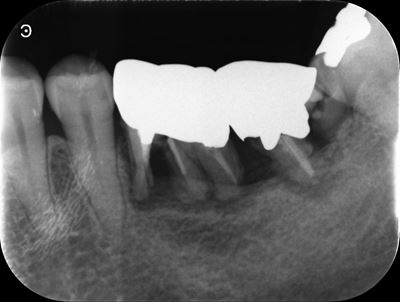 術前X線画像：症例2-2