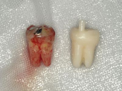 左下8番（ドナー歯）とレプリカ：頬側面観：症例2-7